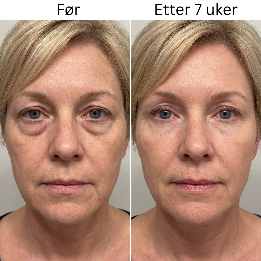 Micro-Infusion Patches