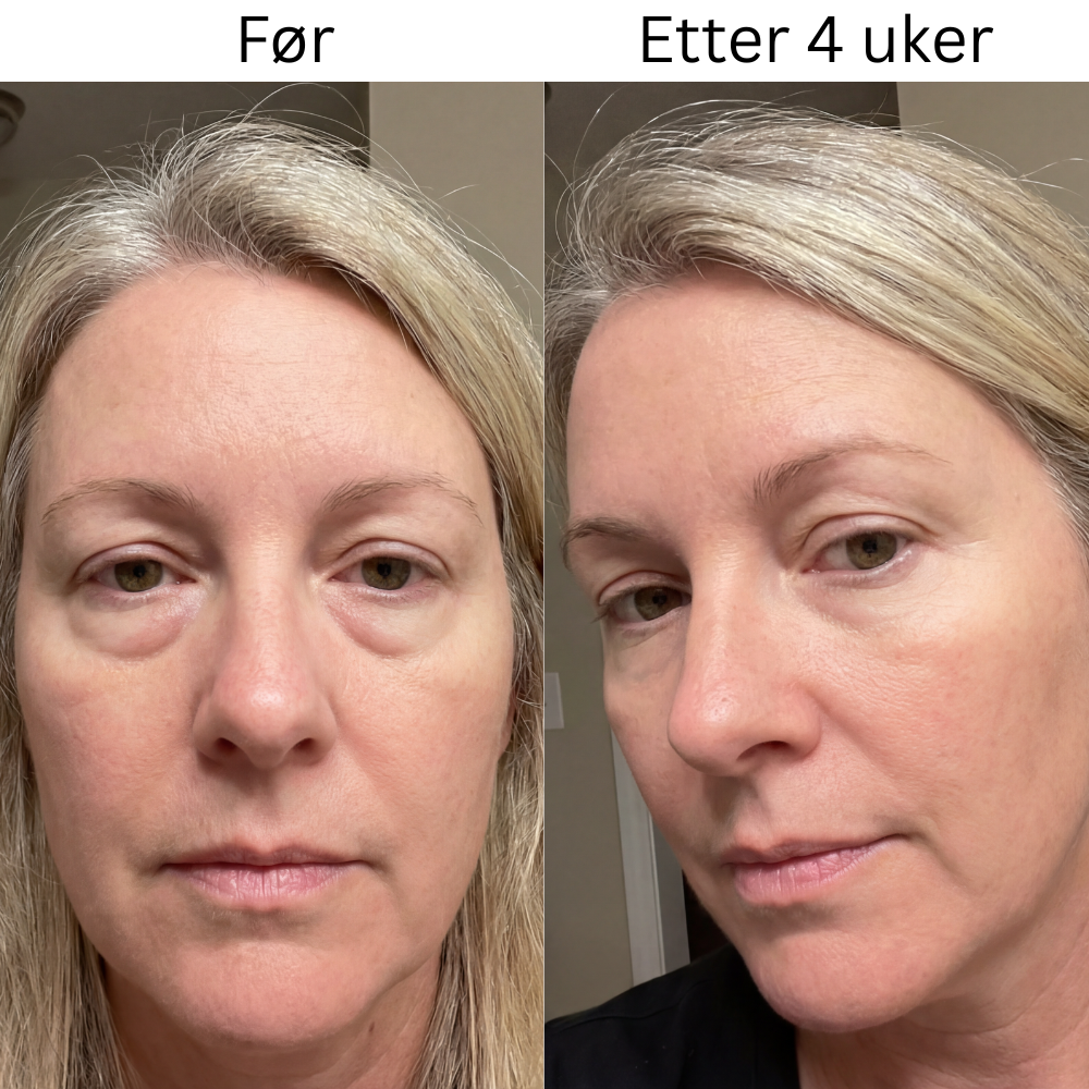 Micro-Infusion Patches